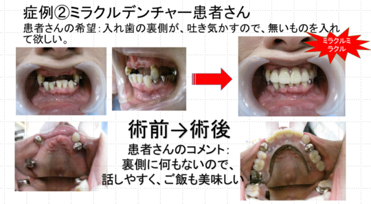 入れ歯（義歯）のブログ - 西村歯科医院