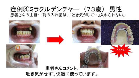 入れ歯（義歯）のブログ - 西村歯科医院