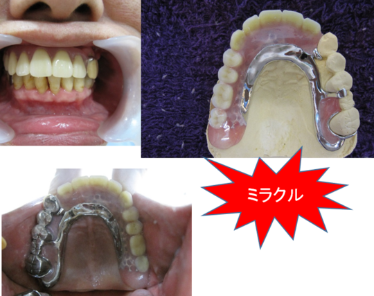 入れ歯（義歯）のブログ - 西村歯科医院