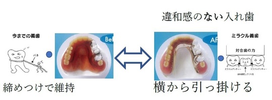 入れ歯（義歯）のブログ - 西村歯科医院