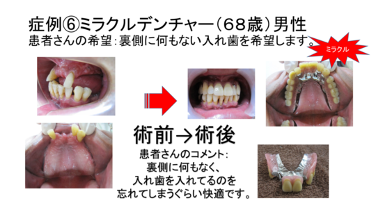 入れ歯（義歯）のブログ - 西村歯科医院