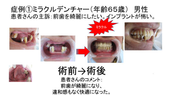 入れ歯（義歯）のブログ - 西村歯科医院